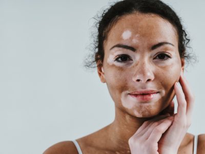 mulher com vitiligo no rosto e o gel PIGMERISE sendo passado