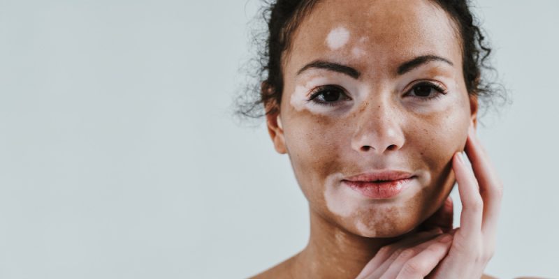 mulher com vitiligo no rosto e o gel PIGMERISE sendo passado